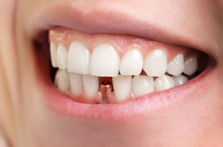 Custom dental crowns and bridges in Melbourne CBD