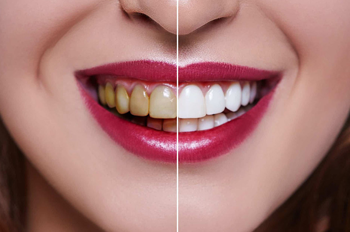 Professional teeth whitening at our Bourke Street dental practice